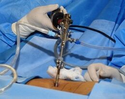 Chirurgická liečba bedrovej osteochondrózy