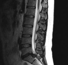 Diagnostické možnosti bedrovej osteochondrózy