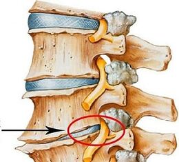 Prečo je bedrová osteochondróza