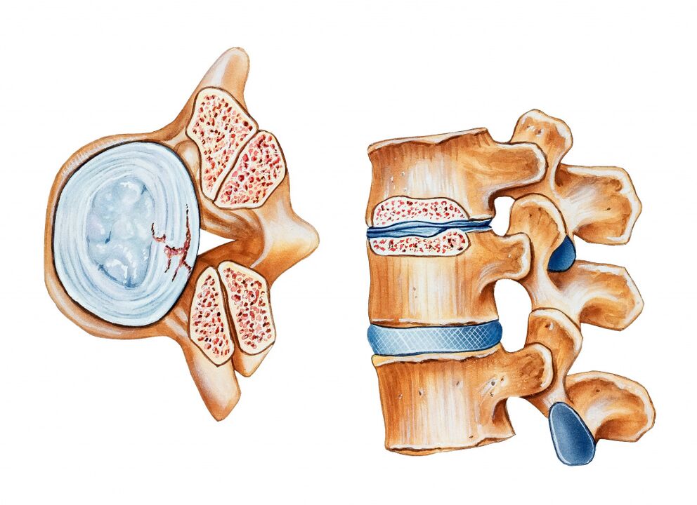 Osteochondróza krčnej oblasti vedie k deštrukcii medzistavcových diskov