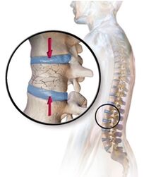 Osteoporóza vyvoláva bolesť chrbta v dolnej časti chrbta